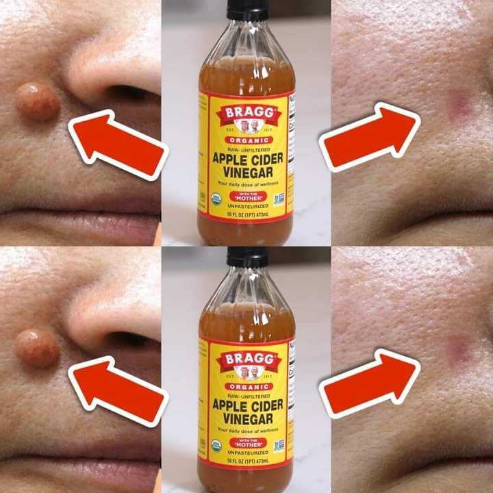 How to get rid of skin tags.